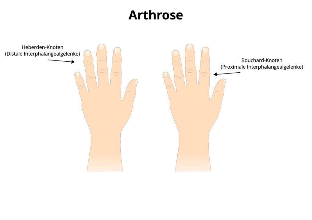 arthrose-der-finger-was-hilft-wirklich