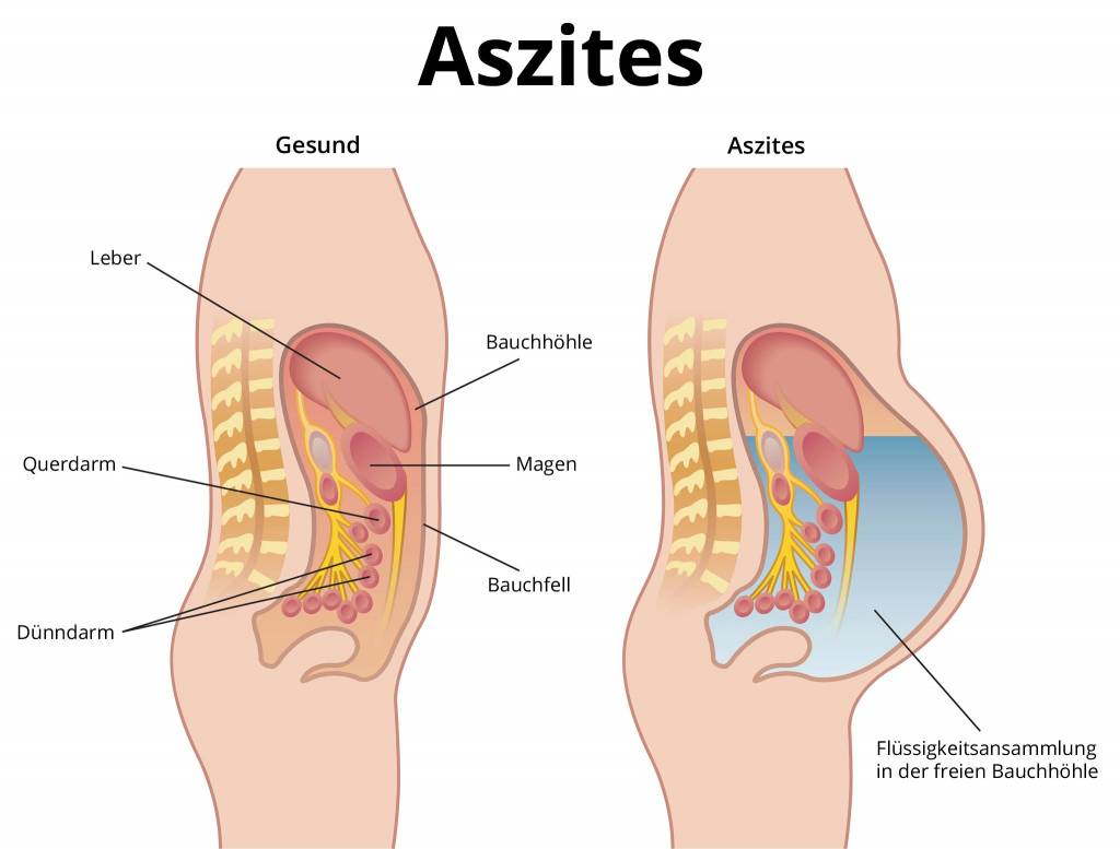 Aszites (Wasser im Bauch) » Ursachen, Symptome, Behandlung