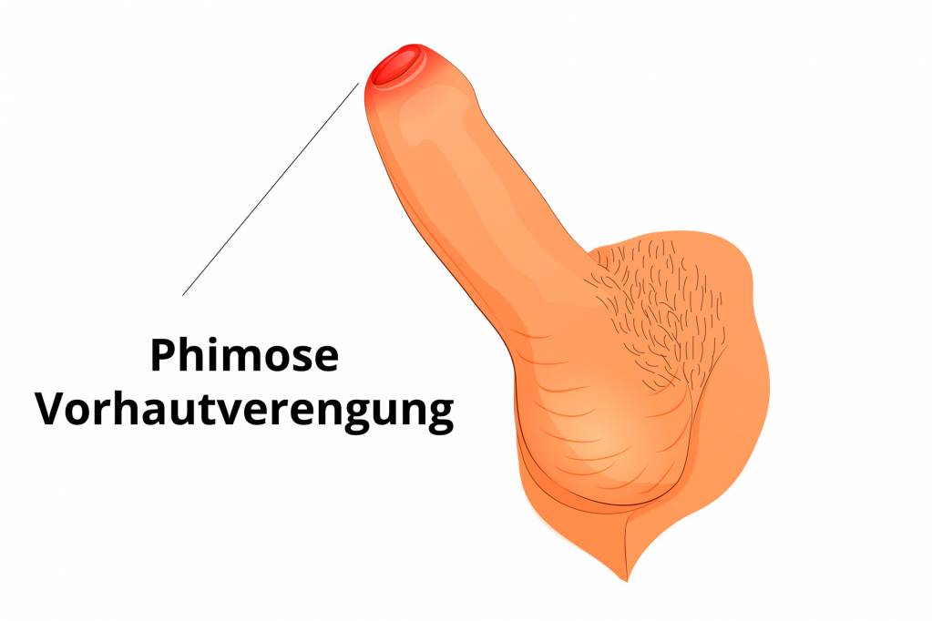 Penis entzündung Entzündung der