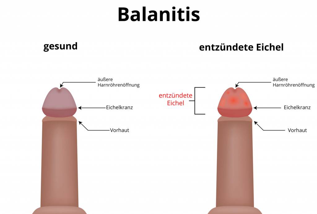 Jucken eichel der rote auf punkte kein Balanitis: Entzündung