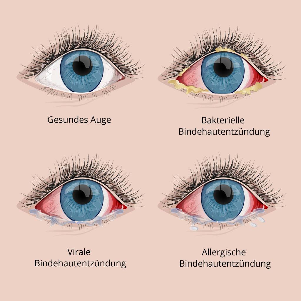 Bindehautentzndung  Ursache, Symptome, Behandlung