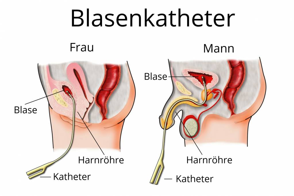 Blasenkatheter Dauerkatheter Blase Wann Ist Er Notwendig