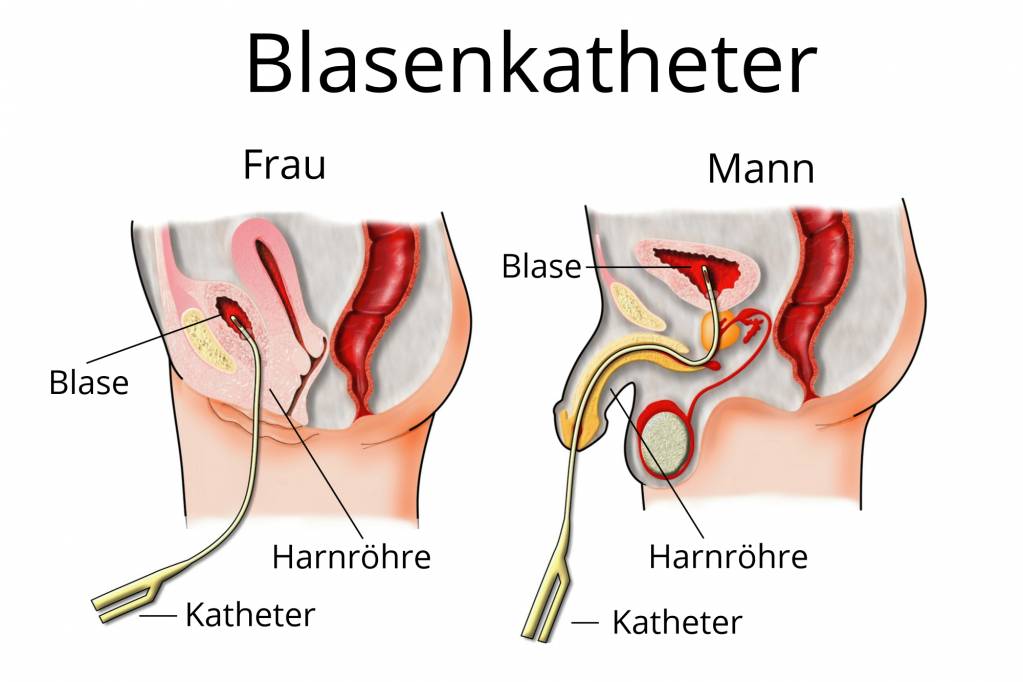 Schmerzen bauchdeckenkatheter Bauchdeckenkatheter