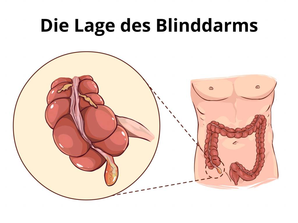 Merkt blinddarm wie geplatzt man Blinddarmoperation