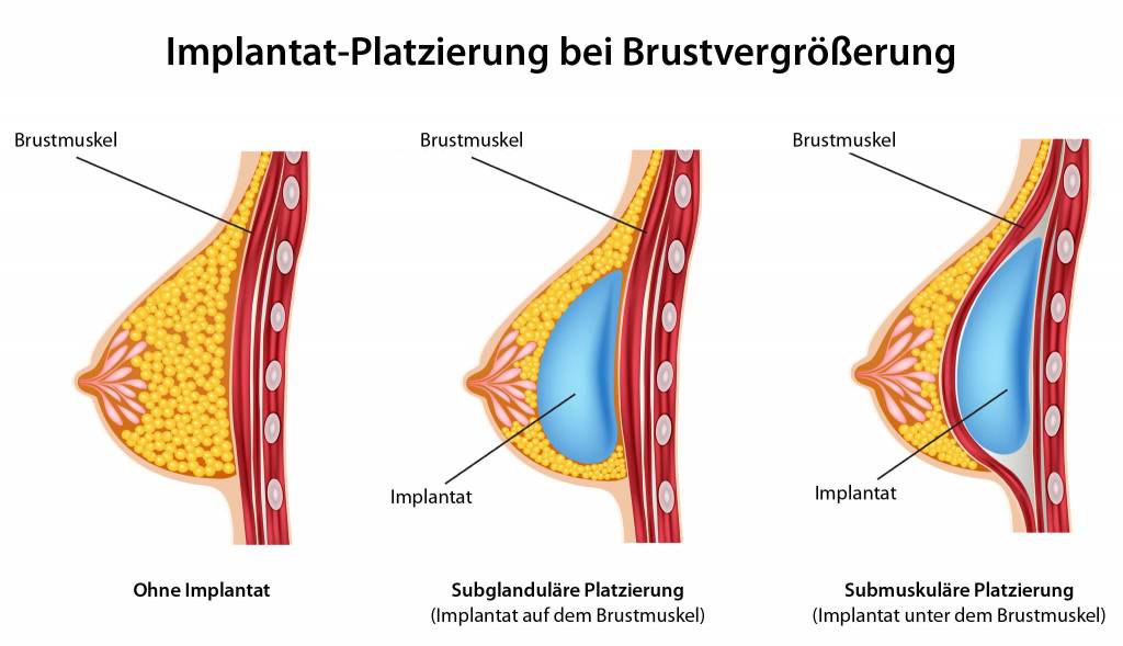 Brustvergrößerung vorher nachher Köln.