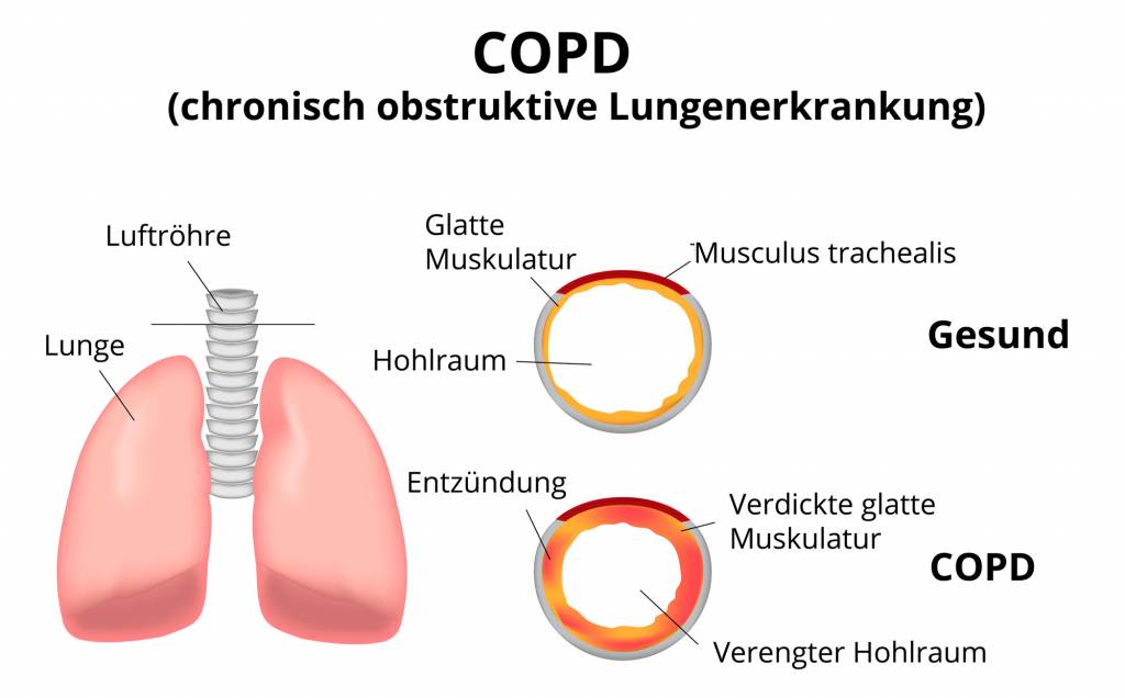Copd Chronisch Obstruktive Lungenerkrankung