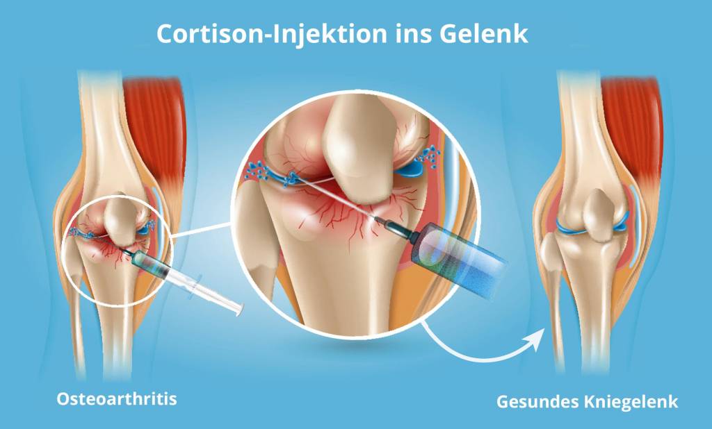 Spritze Ins Gelenk Injektionsbehandlung Einspritzung