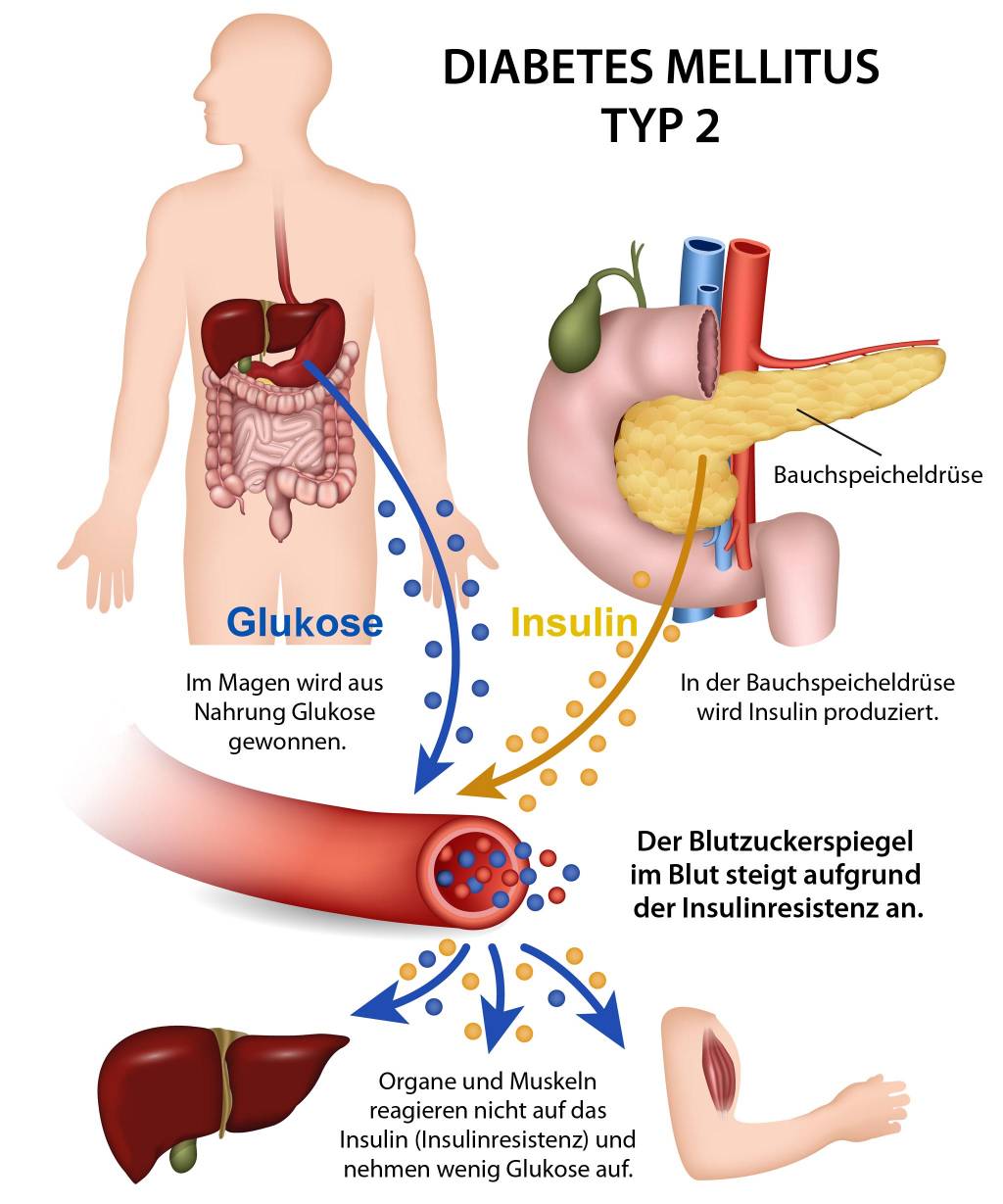 diabetes mellitus typ 2: symptome
