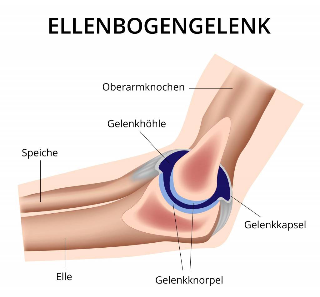 Wie uert sich eine Arthrose am Ellenbogen?