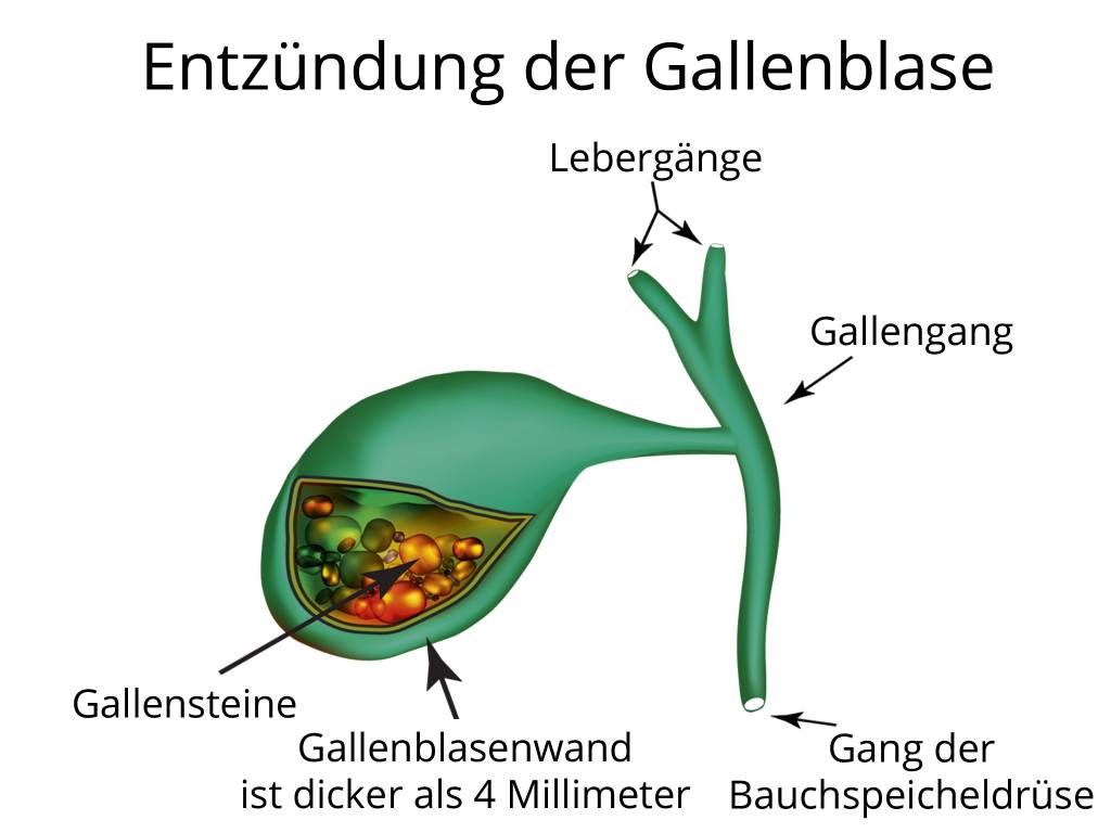 Wie lange krank nach gallen op