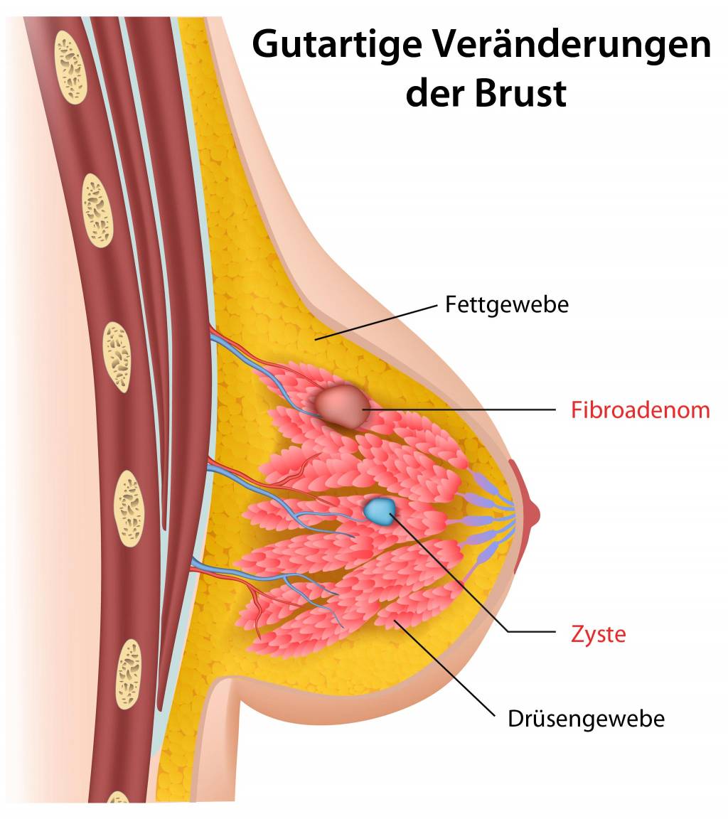 Brustwarze knoten mann unter Knoten in