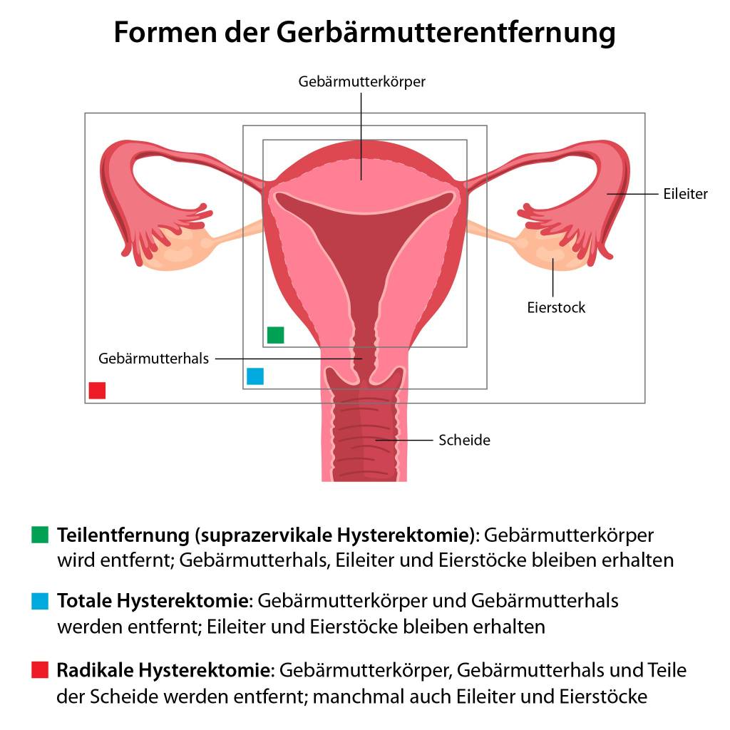 Hellrote blutung nach gebärmutterentfernung
