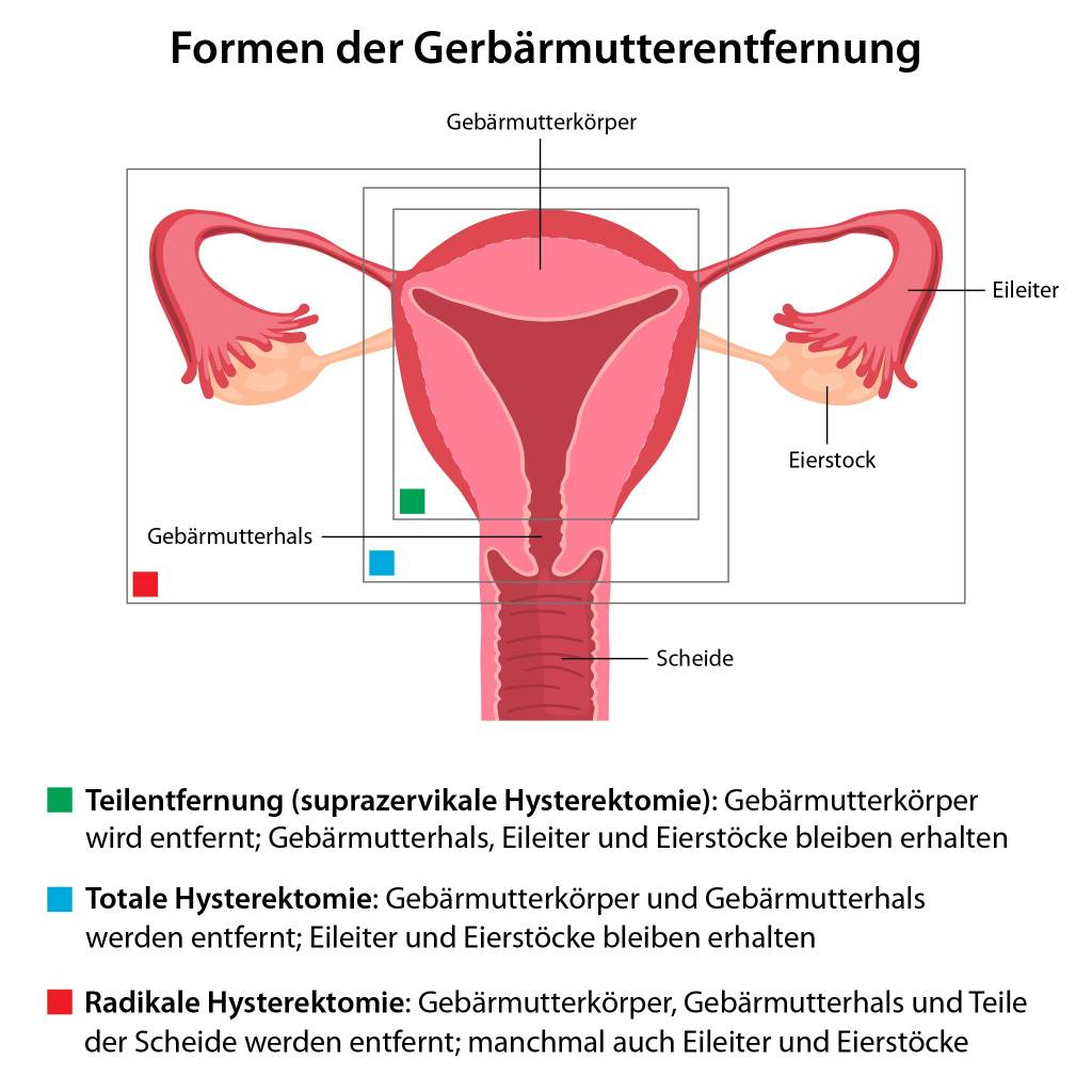 Nach hysterektomie arbeitsunfähigkeit Verhalten nach