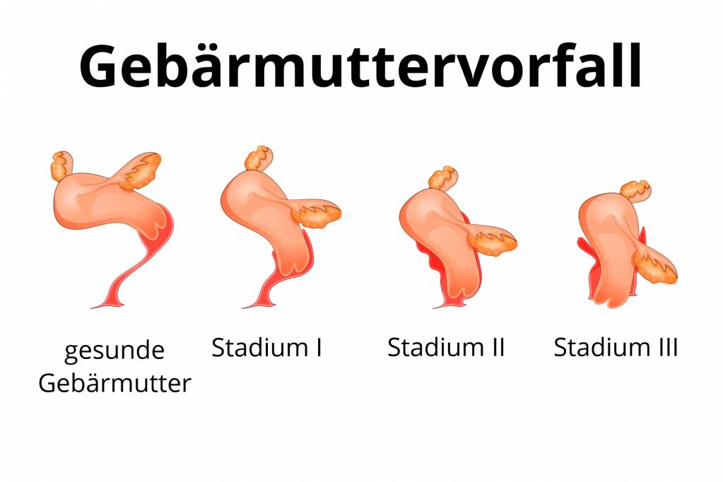 Nach gebärmutterentfernung stuhlgang Hysterektomie, Operation,