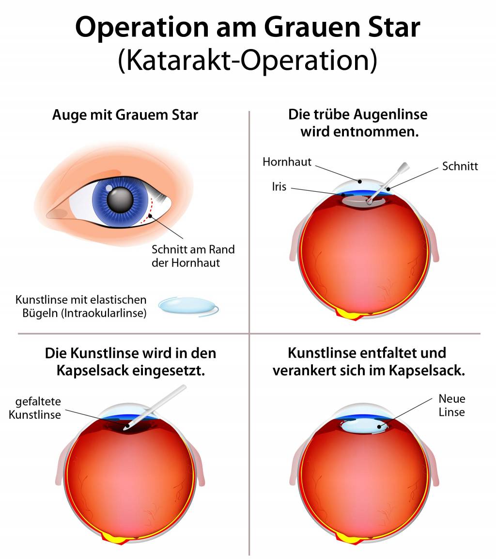 Grauer Star OP, Katarakt-Operation
