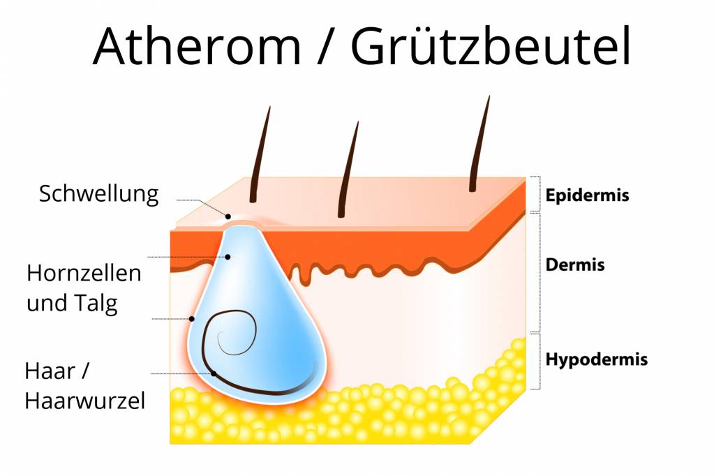 Entfernen talgknoten Talgknoten