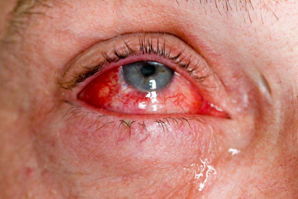 Eine geplatzte Ader im Auge führt zu einer Blutung, die dramatisch aussieht...