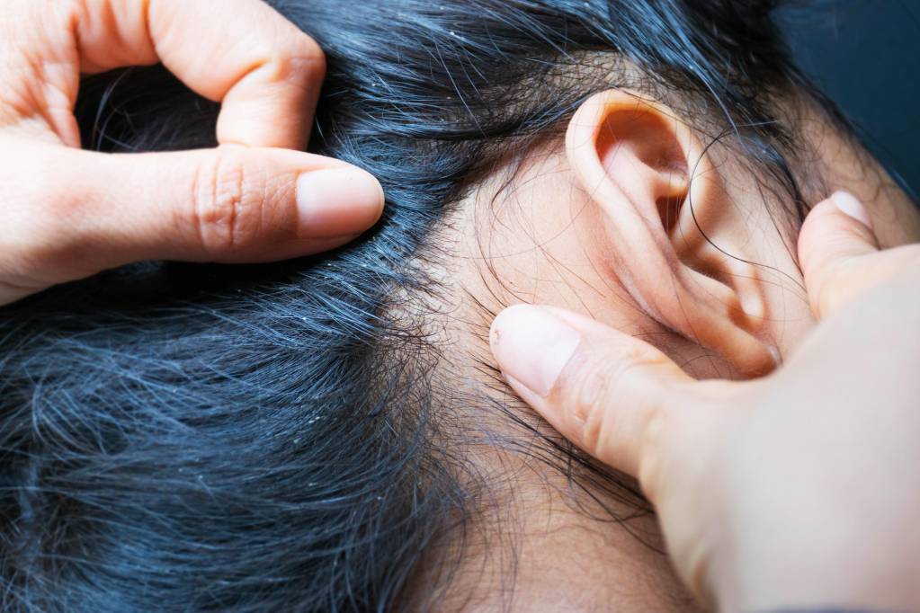 Läuse sehr lange haare Stimmt es,