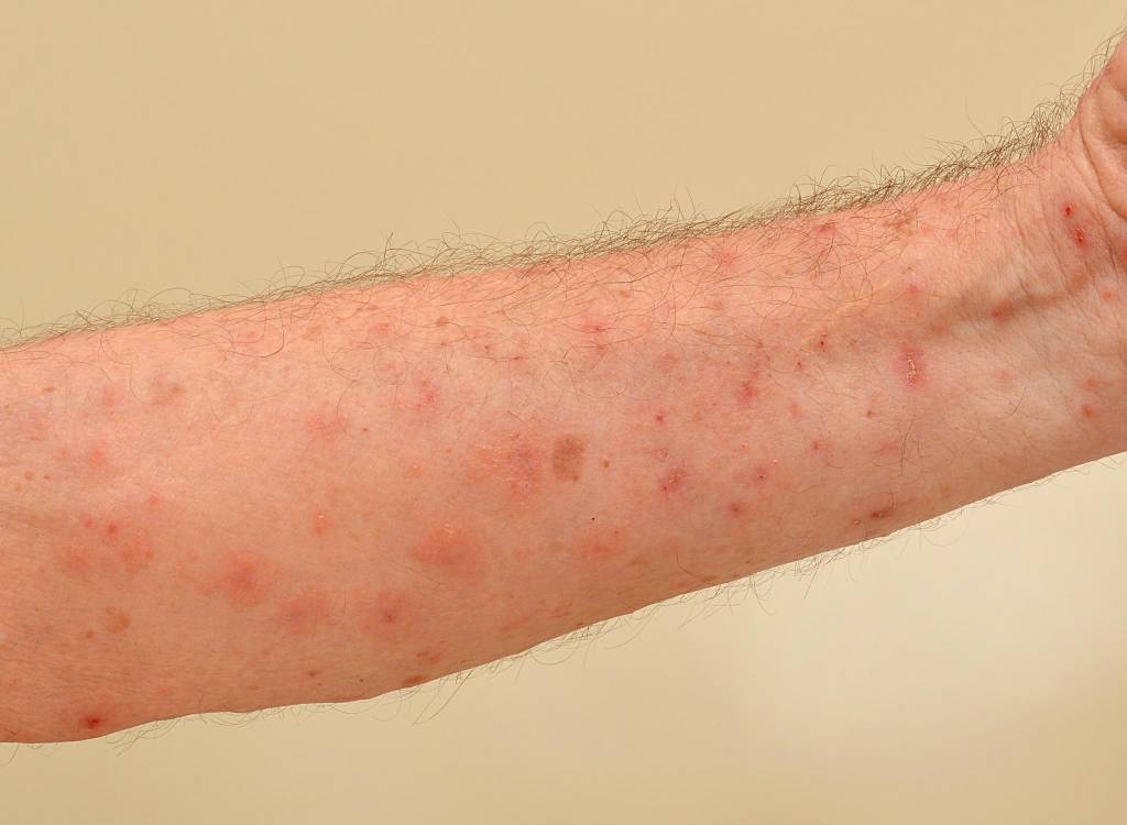 Krätze (Scabies) » Ursache, Beschwerden, Behandlung