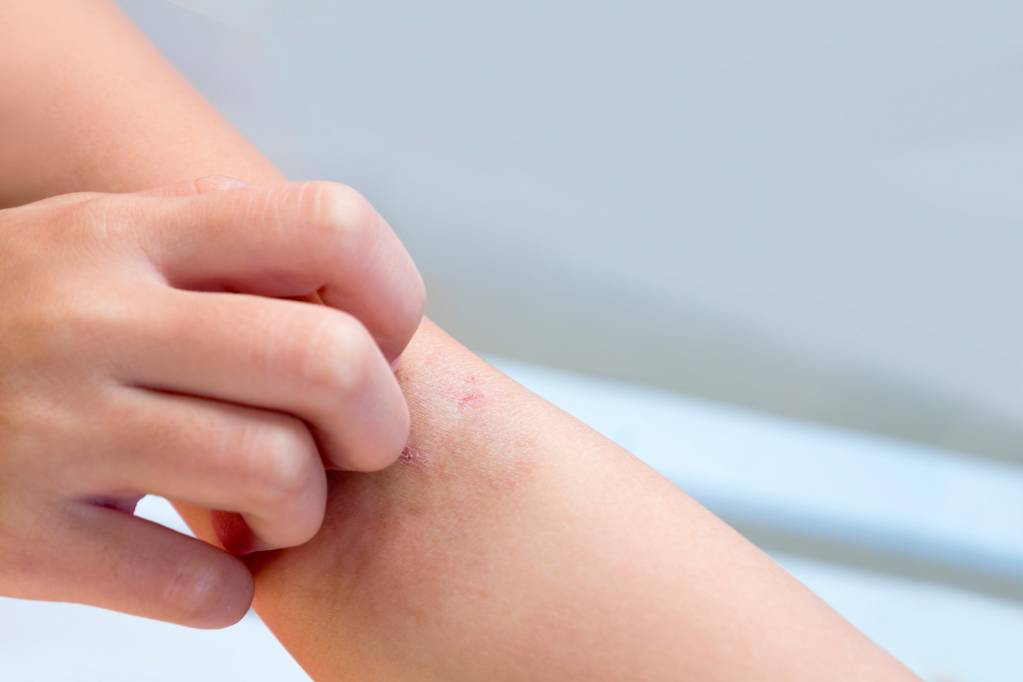 Man krätze erkennt woran Krätze: Symptome
