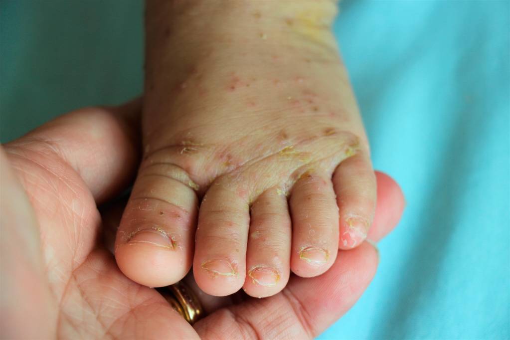 Pusteln behandlung nach neue krätze Scabies/Krätze, trotz