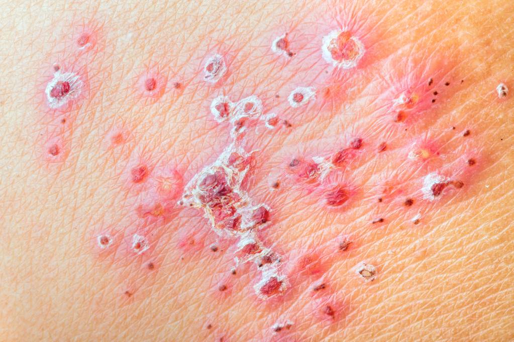 Herpes am rücken woher kommt Herpes auf