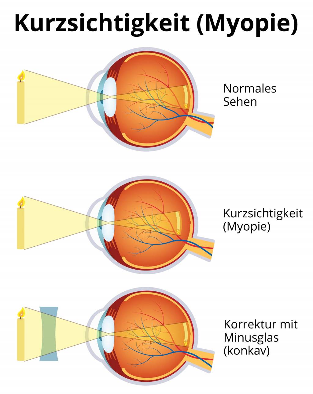 Kurzsichtigkeit | Myopie