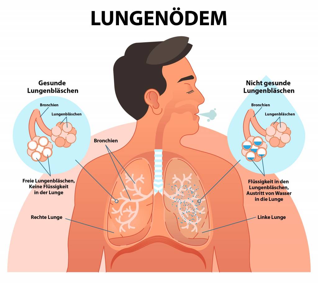 Lungenödem » Wasser in der Lunge