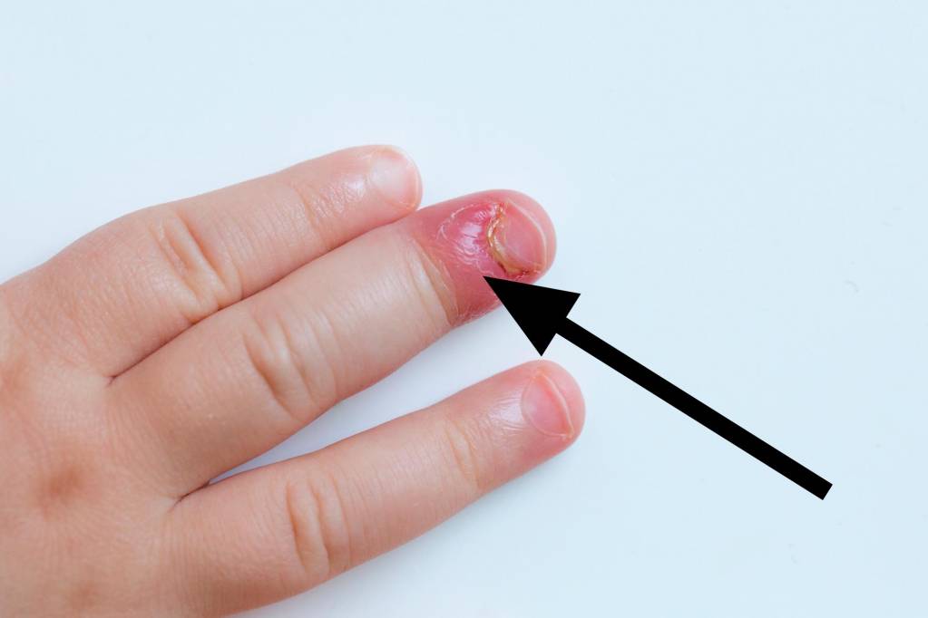 Nagelbettentzündung wildes fleisch finger
