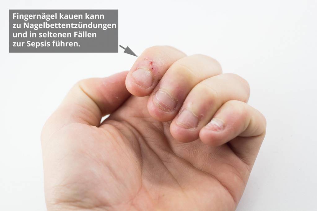 Finger nagelbettentzündung wildes fleisch am Fingernagel?