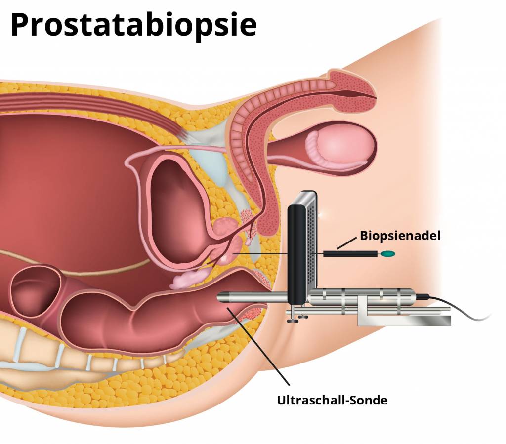 Gutartige Prostatavergrosserung Diagnose Op Ausschalung