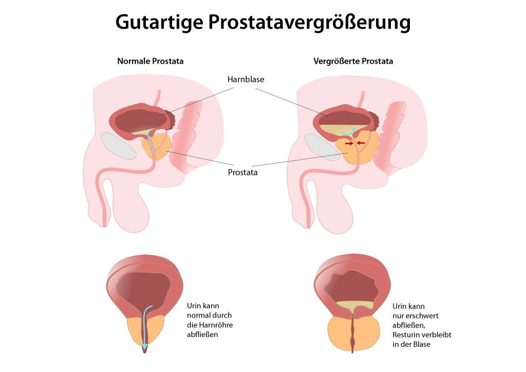 Contraindicatii chirurgie adenom prostata tur