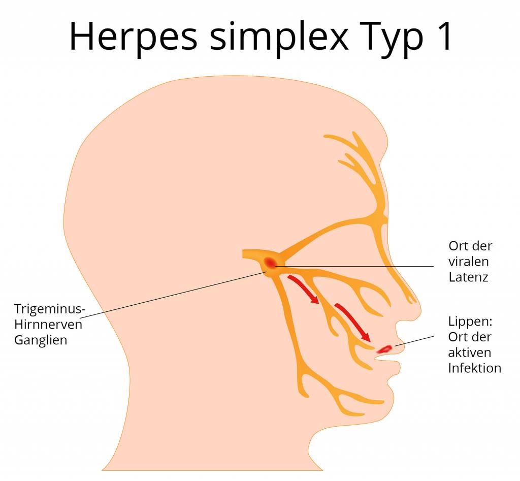 Ansteckung genitalis Herpes genitalis