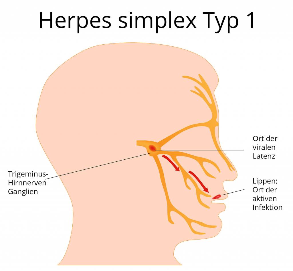 Herpes wie lange bleibt wie lange