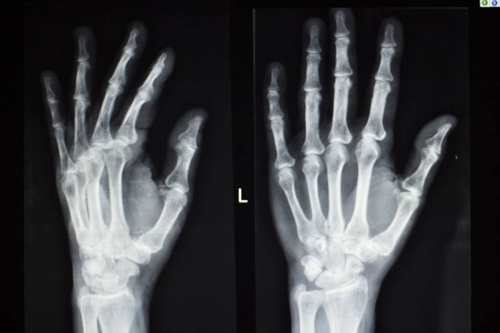 arthrose-der-finger-was-hilft-wirklich