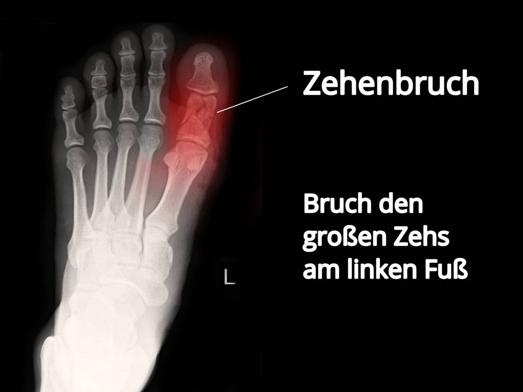 Gebrochener Zeh (Zehenbruch, Zehenfraktur) » wie erkennen?