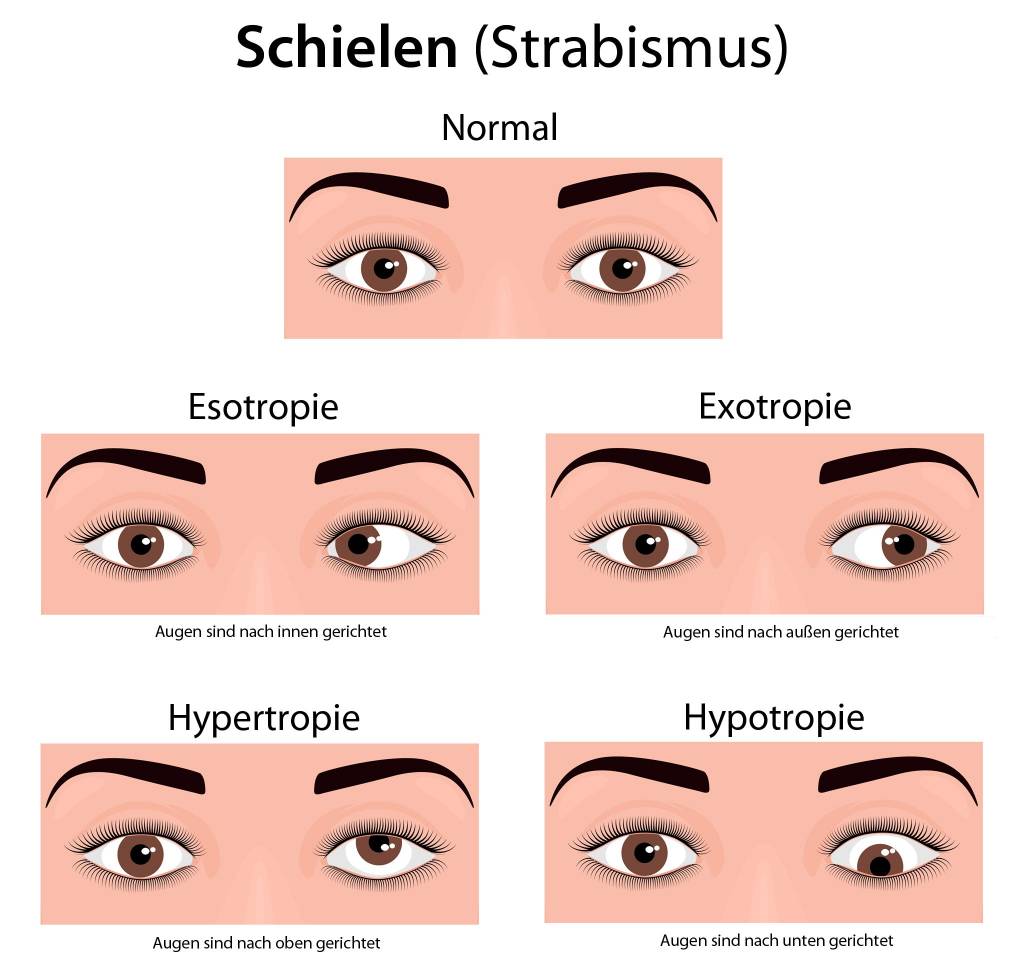 Schielen lernen außen nach Schielen bei