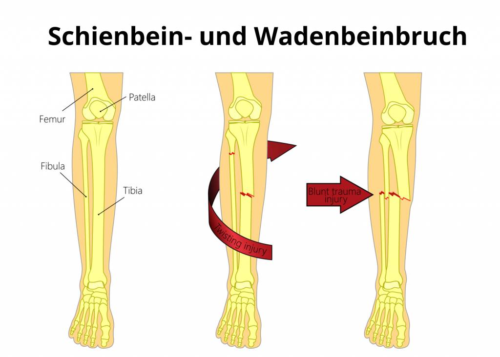 Schienbeinbruch Tibiafraktur Symptome Behandlung