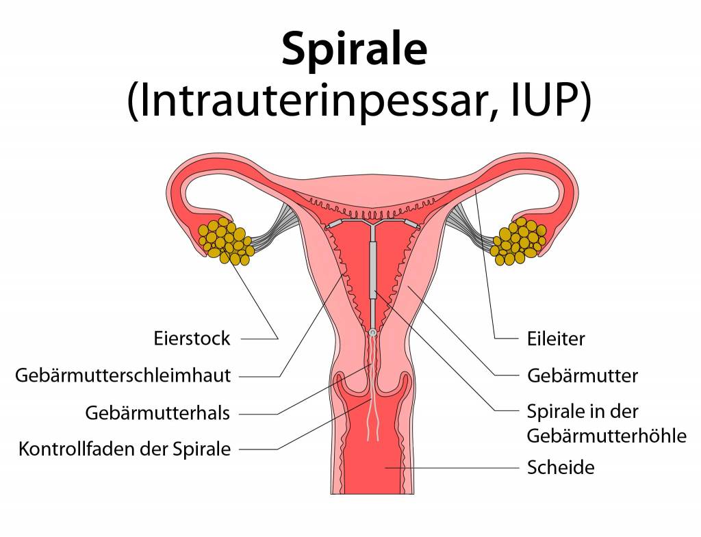 Wie sicher ist die kupferspirale