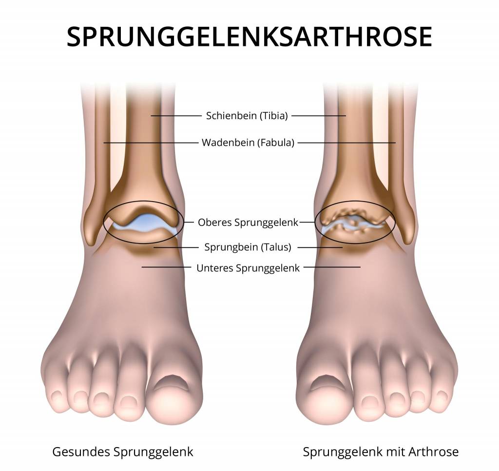Wie uert sich eine Arthrose am Sprunggelenk?