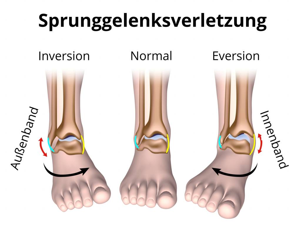 Zum fuß arzt wann umgeknickt Fuß umgeknickt