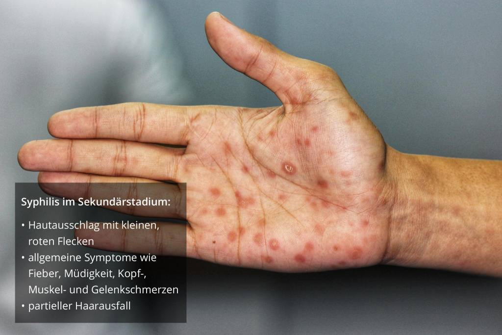 Wie Aussert Sich Eine Syphilis Auf Der Haut