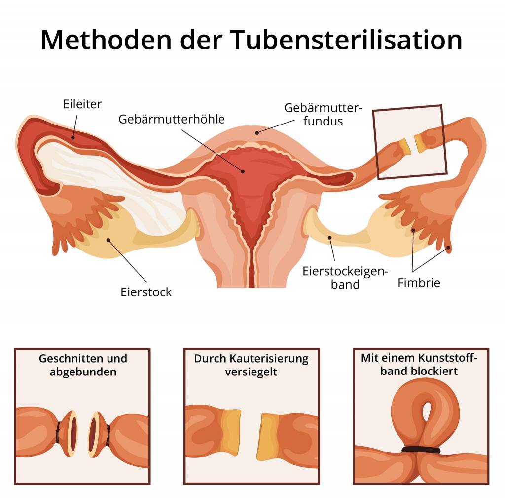 Sterilisation - Tubensterilisation - Dauerhafte Empfngnisverhtung -  Operation