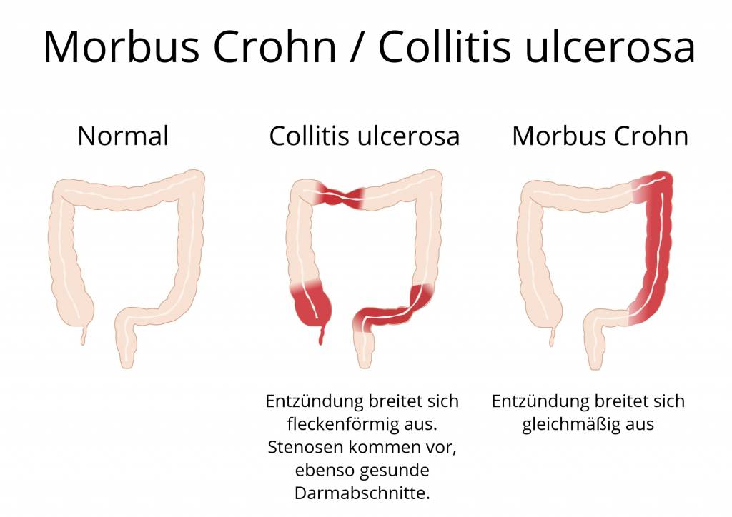 Brote colitis ulcerosa