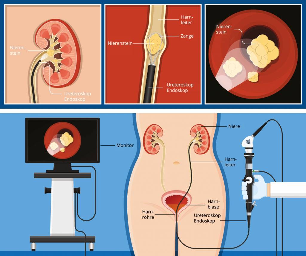 Harnsteine  Ursachen, Diagnose, Behandlung