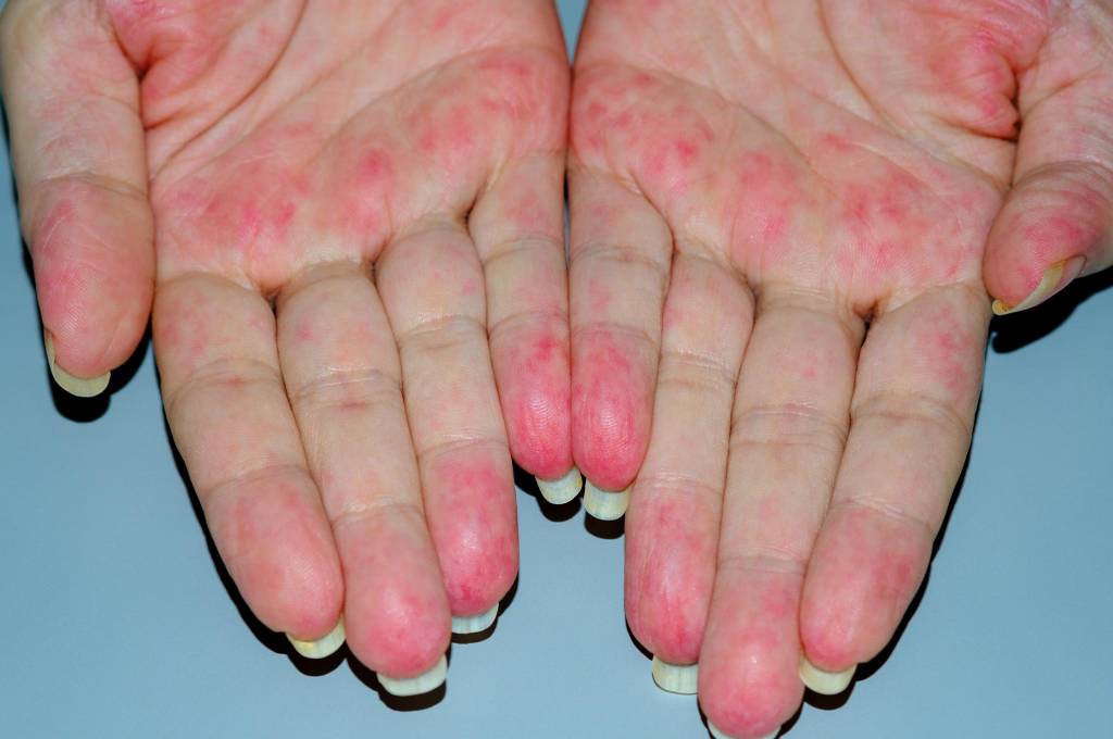 Trombose Finger / Venöse thrombosen betreffen vor allem die beinvenen