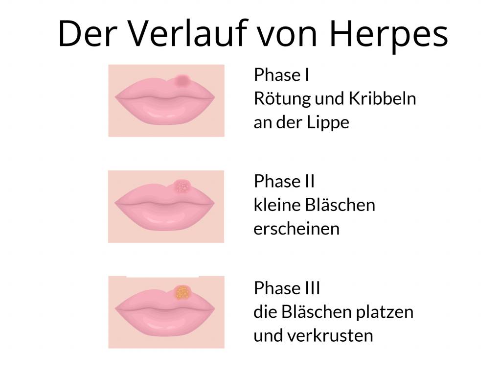 Lange herpes wie bleibt Wie lange