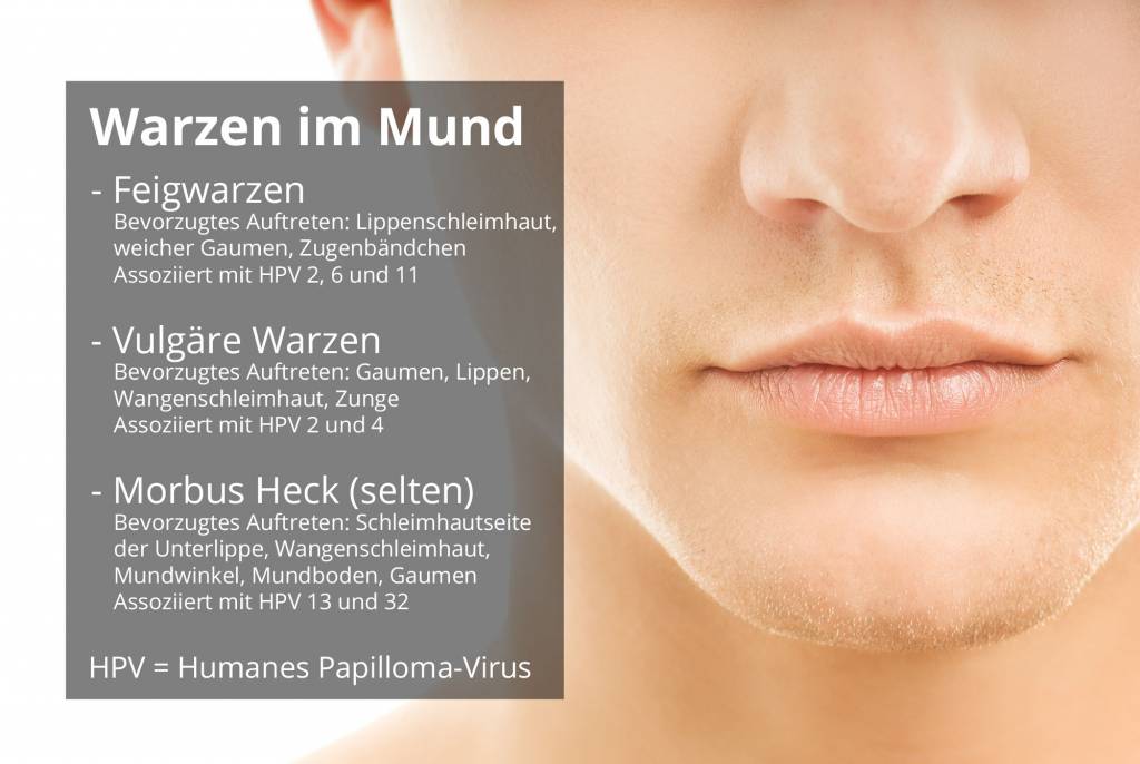 humanes papillomavirus zunge