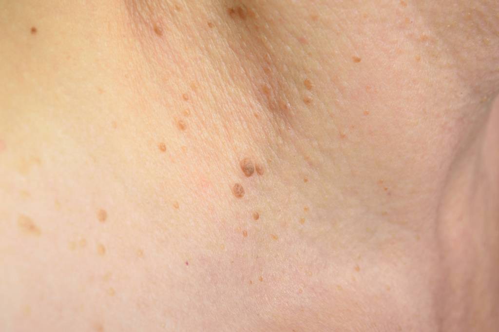 Warzen (Dornwarzen, Feigwarzen, Kondylome) » wie behandeln?