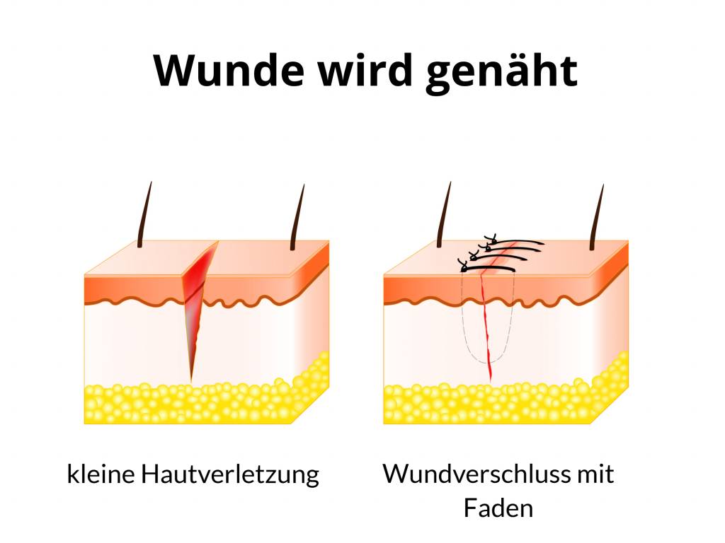 Fäden selbstauflösende lange wie brauchen Brustkrebs